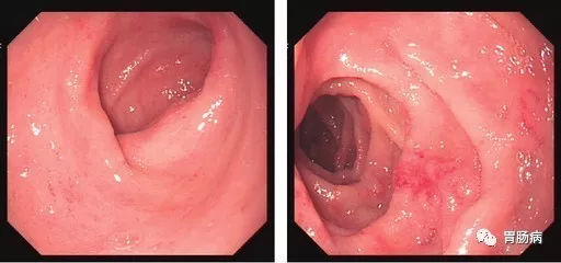 萎縮性胃炎不可怕，只要真正了解它