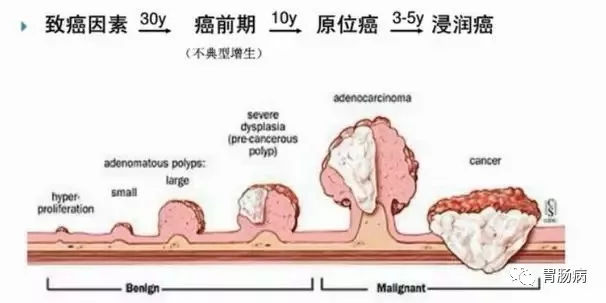 體檢查出腸息肉一定要切除！ 95%腸癌由它演變而來(lái)