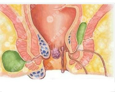 南寧哪個醫(yī)院可以做肛周膿腫？